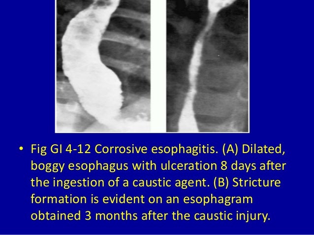 caustic esophagitis